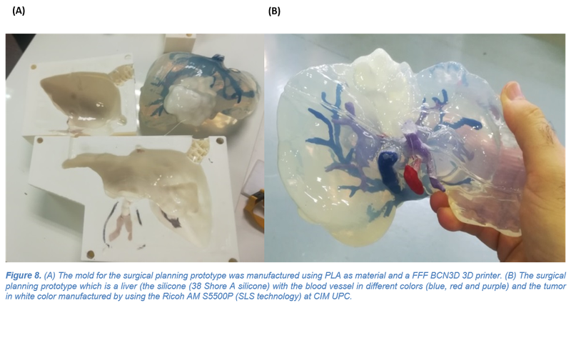 Nou article publicat: "3D Printing in Medicine for Preoperative Surgical Planning: A Review"